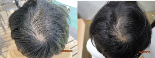 New Hair Regrowth Combo - Image 2