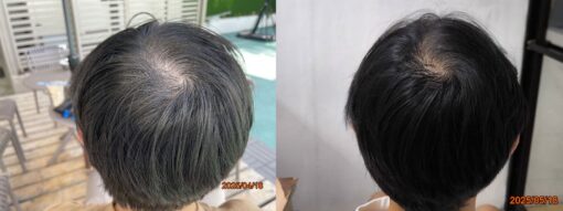 New Hair Regrowth Combo - Image 3