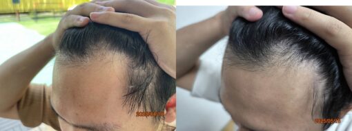 New Hair Regrowth Combo - Image 4